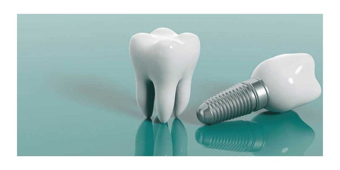 ایمپلنت دندان و انواع ایمپلنت دندان