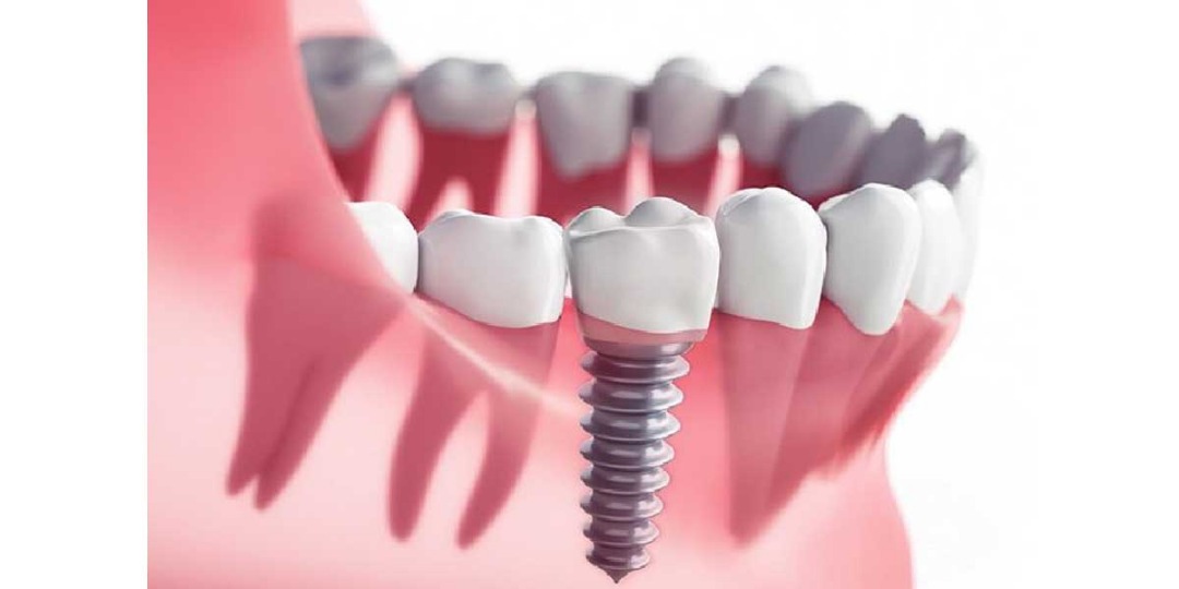 پایا مدیکال مرجع تخصصی فروش ایمپلنت و تجهیزات دندانپزشکی