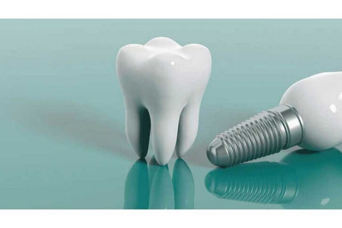 ایمپلنت دندان، تجهیزات دندانپزشکی، پایا مدیکال